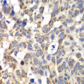 PARN Antibody - Immunohistochemistry of paraffin-embedded human esophageal cancer tissue.