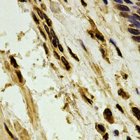 PARN Antibody - Immunohistochemical analysis of PARN staining in human esophageal cancer formalin fixed paraffin embedded tissue section. The section was pre-treated using heat mediated antigen retrieval with sodium citrate buffer (pH 6.0). The section was then incubated with the antibody at room temperature and detected using an HRP conjugated compact polymer system. DAB was used as the chromogen. The section was then counterstained with hematoxylin and mounted with DPX.