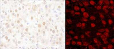 PARP1 Antibody - Detection of Human PARP1 by Immunohistochemistry and Immunofluorescence. Sample: FFPE sections of human breast carcinoma. Antibody: Affinity purified rabbit anti-PARP1 used at a dilution of 1:200 (1 ug/ml) and 1:80 (2.5 ug/ml). Detection: DAB and Red-fluorescent Goat anti-Rabbit IgG-heavy and light chain, cross-adsorbed Antibody DyLight 594 Conjugated used at a dilution of 1:100.