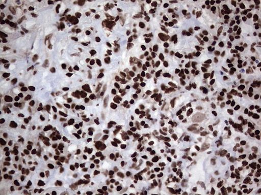 PARP1 Antibody - Immunohistochemical staining of paraffin-embedded Carcinoma of Human lung tissue using anti-PARP1 mouse monoclonal antibody. (Heat-induced epitope retrieval by 1 mM EDTA in 10mM Tris, pH8.5, 120C for 3min,