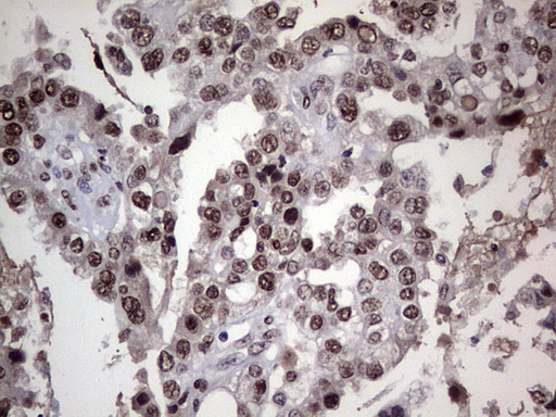 PARP1 Antibody - Immunohistochemical staining of paraffin-embedded Adenocarcinoma of Human ovary tissue using anti-PARP1 mouse monoclonal antibody. (Heat-induced epitope retrieval by 1 mM EDTA in 10mM Tris, pH8.5, 120C for 3min,