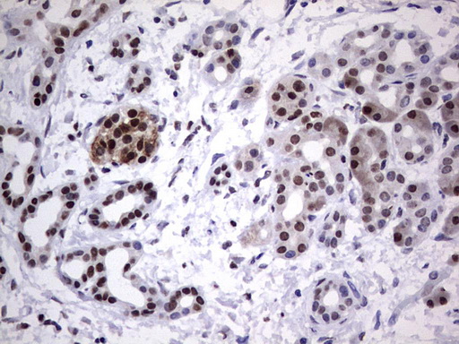 PARP1 Antibody - Immunohistochemical staining of paraffin-embedded Carcinoma of Human pancreas tissue using anti-PARP1 mouse monoclonal antibody. (Heat-induced epitope retrieval by 1 mM EDTA in 10mM Tris, pH8.5, 120C for 3min,