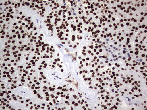 PARP1 Antibody - Immunohistochemical staining of paraffin-embedded Carcinoma of Human thyroid tissue using anti-PARP1 mouse monoclonal antibody. (Heat-induced epitope retrieval by 1 mM EDTA in 10mM Tris, pH8.5, 120C for 3min,