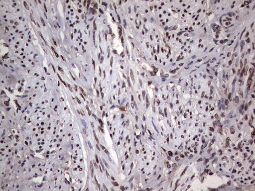 PARP1 Antibody - Immunohistochemical staining of paraffin-embedded Human endometrium tissue within the normal limits using anti-PARP1 mouse monoclonal antibody. (Heat-induced epitope retrieval by 1 mM EDTA in 10mM Tris, pH8.5, 120C for 3min,