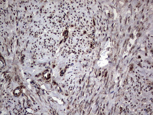 PARP1 Antibody - Immunohistochemical staining of paraffin-embedded Adenocarcinoma of Human endometrium tissue using anti-PARP1 mouse monoclonal antibody. (Heat-induced epitope retrieval by 1 mM EDTA in 10mM Tris, pH8.5, 120C for 3min,