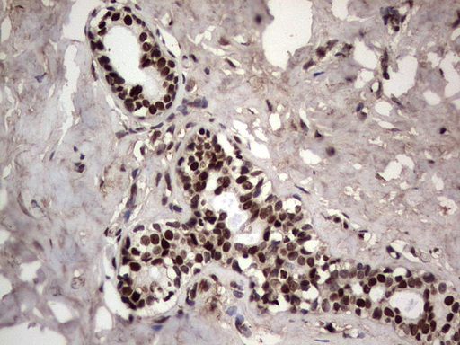 PARP1 Antibody - Immunohistochemical staining of paraffin-embedded Adenocarcinoma of Human breast tissue using anti-PARP1 mouse monoclonal antibody. (Heat-induced epitope retrieval by 1 mM EDTA in 10mM Tris, pH8.5, 120C for 3min,
