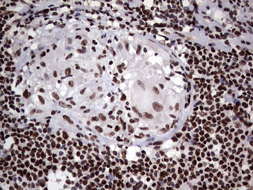 PARP1 Antibody - Immunohistochemical staining of paraffin-embedded Human lymph node tissue within the normal limits using anti-PARP1 mouse monoclonal antibody. (Heat-induced epitope retrieval by 1 mM EDTA in 10mM Tris, pH8.5, 120C for 3min,