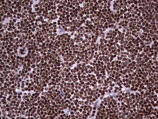 PARP1 Antibody - Immunohistochemical staining of paraffin-embedded Human lymphoma tissue using anti-PARP1 mouse monoclonal antibody. (Heat-induced epitope retrieval by 1 mM EDTA in 10mM Tris, pH8.5, 120C for 3min,