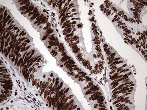 PARP1 Antibody - Immunohistochemical staining of paraffin-embedded Adenocarcinoma of Human colon tissue using anti-PARP1 mouse monoclonal antibody. (Heat-induced epitope retrieval by 1 mM EDTA in 10mM Tris, pH8.5, 120C for 3min,