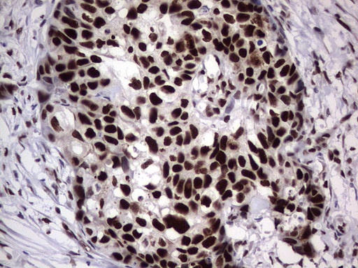 PARP1 Antibody - Immunohistochemical staining of paraffin-embedded Carcinoma of Human kidney tissue using anti-PARP1 mouse monoclonal antibody. (Heat-induced epitope retrieval by 1 mM EDTA in 10mM Tris, pH8.5, 120C for 3min,