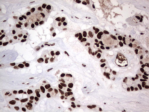 PARP1 Antibody - Immunohistochemical staining of paraffin-embedded Carcinoma of Human liver tissue using anti-PARP1 mouse monoclonal antibody. (Heat-induced epitope retrieval by 1 mM EDTA in 10mM Tris, pH8.5, 120C for 3min,