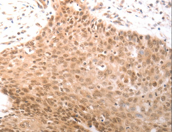 PARP1 Antibody - Immunohistochemistry of paraffin-embedded Human cervical cancer using PARP1 Polyclonal Antibody at dilution of 1:25.