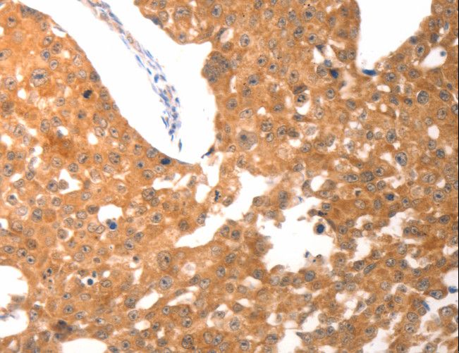 PARP1 Antibody - Immunohistochemistry of paraffin-embedded Human breast cancer using PARP1 Polyclonal Antibody at dilution of 1:25.