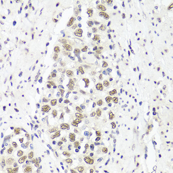 PARP1 Antibody - Immunohistochemistry of paraffin-embedded human esophageal cancer tissue.