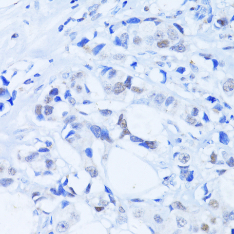 PARP1 Antibody - Immunohistochemistry of paraffin-embedded human breast cancer using PARP1 Antibodyat dilution of 1:100 (40x lens).