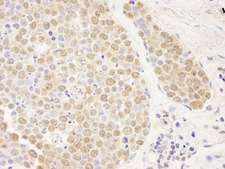 PARP10 Antibody - Detection of Human PARP10 by Immunohistochemistry. Sample: FFPE section of human small cell lung cancer. Antibody: Affinity purified rabbit anti-PARP10 used at a dilution of 1:250.
