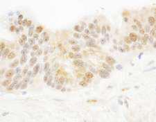 PARP10 Antibody - Detection of Human PARP10 by Immunohistochemistry. Sample: FFPE section of human ovarian carcinoma. Antibody: Affinity purified rabbit anti-PARP10 used at a dilution of 1:1000 (1 ug/ml). Detection: DAB.
