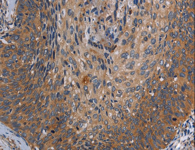 PARP10 Antibody - Immunohistochemistry of paraffin-embedded Human cervical cancer using PARP10 Polyclonal Antibody at dilution of 1:30.