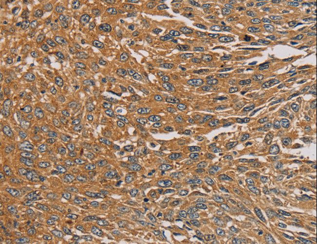 PARP11 Antibody - Immunohistochemistry of paraffin-embedded Human lung cancer using PARP11 Polyclonal Antibody at dilution of 1:30.