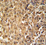PARP13 / ZC3HAV1 Antibody - ZC3HAV1 Antibody immunohistochemistry of formalin-fixed and paraffin-embedded human cervix carcinoma followed by peroxidase-conjugated secondary antibody and DAB staining.