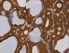 PARP3 Antibody - Immunohistochemistry of paraffin-embedded Human liver cancer using PARP3 Polyclonal Antibody at dilution of 1:40.