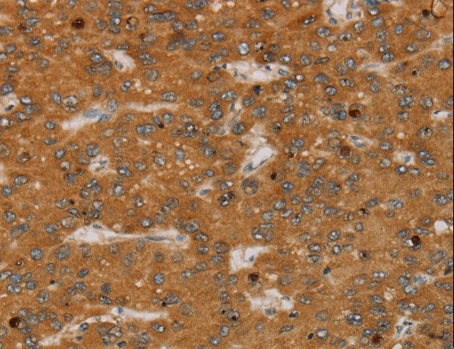 PARP3 Antibody - Immunohistochemistry of paraffin-embedded Human liver cancer using PARP3 Polyclonal Antibody at dilution of 1:40.