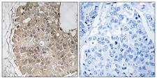PARP4 / VPARP Antibody - Immunohistochemistry analysis of paraffin-embedded human breast carcinoma, using PARP4 Antibody. The picture on the right is blocked with the synthesized peptide.