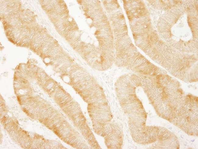 PARP4 / VPARP Antibody - Detection of Human vPARP by Immunohistochemistry. Sample: FFPE section of human colon carcinoma. Antibody: Affinity purified rabbit anti-vPARP used at a dilution of 1:200 (1 ug/ml). Detection: DAB.