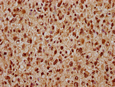 PARP7 / TIPARP Antibody - Immunohistochemistry Dilution at 1:300 and staining in paraffin-embedded human glioma cancer performed on a Leica BondTM system. After dewaxing and hydration, antigen retrieval was mediated by high pressure in a citrate buffer (pH 6.0). Section was blocked with 10% normal Goat serum 30min at RT. Then primary antibody (1% BSA) was incubated at 4°C overnight. The primary is detected by a biotinylated Secondary antibody and visualized using an HRP conjugated SP system.