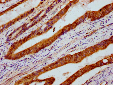 PARS2 Antibody - Immunohistochemistry Dilution at 1:300 and staining in paraffin-embedded human colon cancer performed on a Leica BondTM system. After dewaxing and hydration, antigen retrieval was mediated by high pressure in a citrate buffer (pH 6.0). Section was blocked with 10% normal Goat serum 30min at RT. Then primary antibody (1% BSA) was incubated at 4°C overnight. The primary is detected by a biotinylated Secondary antibody and visualized using an HRP conjugated SP system.