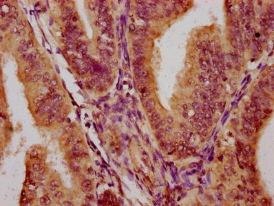 PARS2 Antibody - Immunohistochemistry Dilution at 1:300 and staining in paraffin-embedded human endometrial cancer performed on a Leica BondTM system. After dewaxing and hydration, antigen retrieval was mediated by high pressure in a citrate buffer (pH 6.0). Section was blocked with 10% normal Goat serum 30min at RT. Then primary antibody (1% BSA) was incubated at 4°C overnight. The primary is detected by a biotinylated Secondary antibody and visualized using an HRP conjugated SP system.