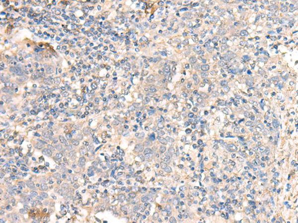 PARS2 Antibody - Immunohistochemistry of paraffin-embedded Human cervical cancer tissue  using PARS2 Polyclonal Antibody at dilution of 1:30(×200)