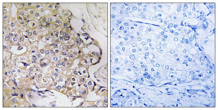 PART1 Antibody - Peptide - + Immunohistochemistry analysis of paraffin-embedded human breast carcinoma tissue using PART1 antibody.