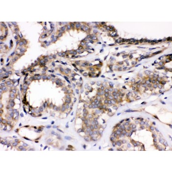 PARVA Antibody - Parvin alpha antibody IHC-paraffin. IHC(P): Human Mammary Cancer Tissue.