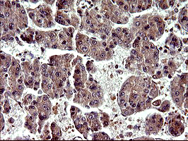 PARVA Antibody - IHC of paraffin-embedded Carcinoma of Human liver tissue using anti-PARVA mouse monoclonal antibody. (Heat-induced epitope retrieval by 10mM citric buffer, pH6.0, 120°C for 3min).
