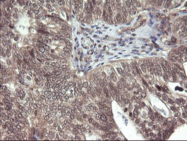 PARVA Antibody - IHC of paraffin-embedded Adenocarcinoma of Human breast tissue using anti-PARVA mouse monoclonal antibody.
