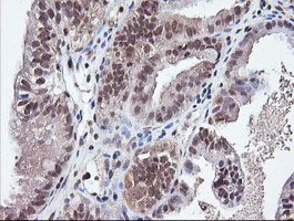 PARVA Antibody - IHC of paraffin-embedded Adenocarcinoma of Human ovary tissue using anti-PARVA mouse monoclonal antibody.