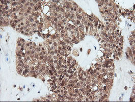 PARVA Antibody - IHC of paraffin-embedded Carcinoma of Human pancreas tissue using anti-PARVA mouse monoclonal antibody.