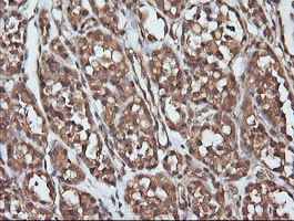 PARVA Antibody - IHC of paraffin-embedded Carcinoma of Human thyroid tissue using anti-PARVA mouse monoclonal antibody.