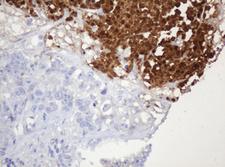 PARVB Antibody - IHC of paraffin-embedded Adenocarcinoma of Human colon tissue using anti-PARVB mouse monoclonal antibody.