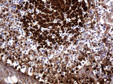 PARVB Antibody - IHC of paraffin-embedded Adenocarcinoma of Human colon tissue using anti-PARVB mouse monoclonal antibody. (Heat-induced epitope retrieval by 10mM citric buffer, pH6.0, 120°C for 3min).