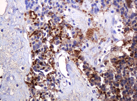 PARVB Antibody - IHC of paraffin-embedded Carcinoma of Human pancreas tissue using anti-PARVB mouse monoclonal antibody. (Heat-induced epitope retrieval by 10mM citric buffer, pH6.0, 120°C for 3min).