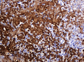 PARVB Antibody - IHC of paraffin-embedded Adenocarcinoma of Human colon tissue using anti-PARVB mouse monoclonal antibody. (Heat-induced epitope retrieval by 10mM citric buffer, pH6.0, 120°C for 3min).