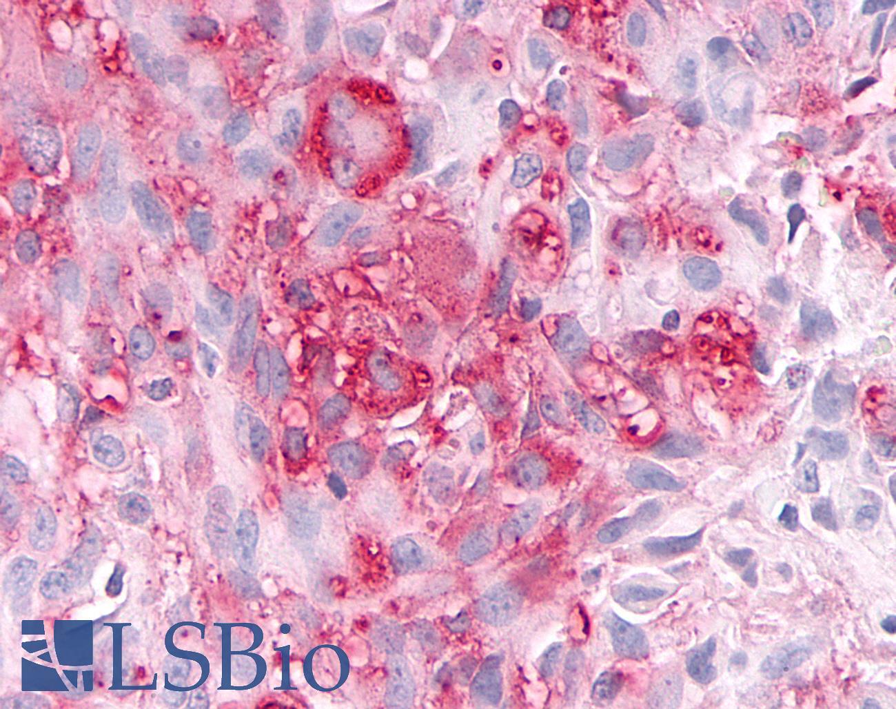 ADAMTS4 Antibody - Brain, Glioblastoma
