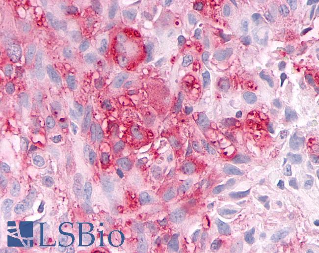ADAMTS4 Antibody - Brain, Glioblastoma
