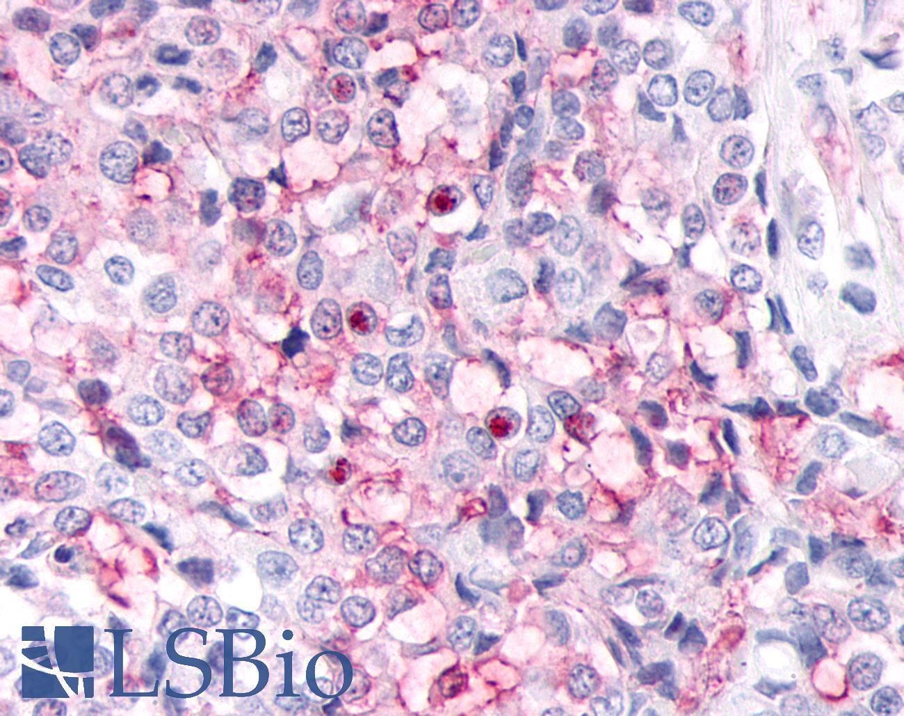 ADAMTS4 Antibody - Breast, Carcinoma