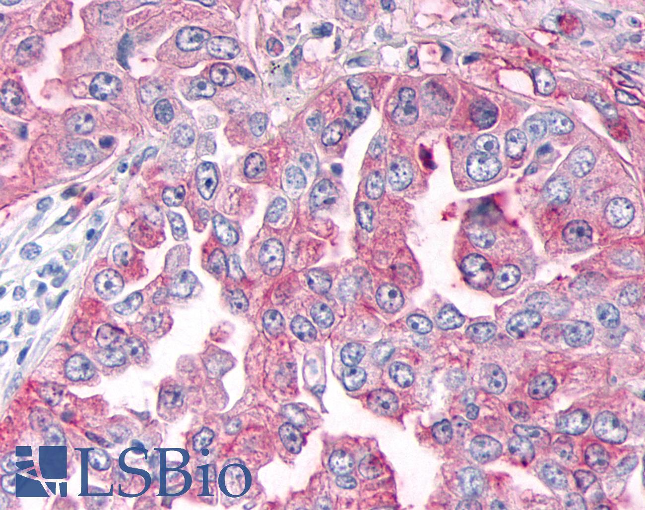ADAMTS4 Antibody - Lung, Non Small-Cell Carcinoma