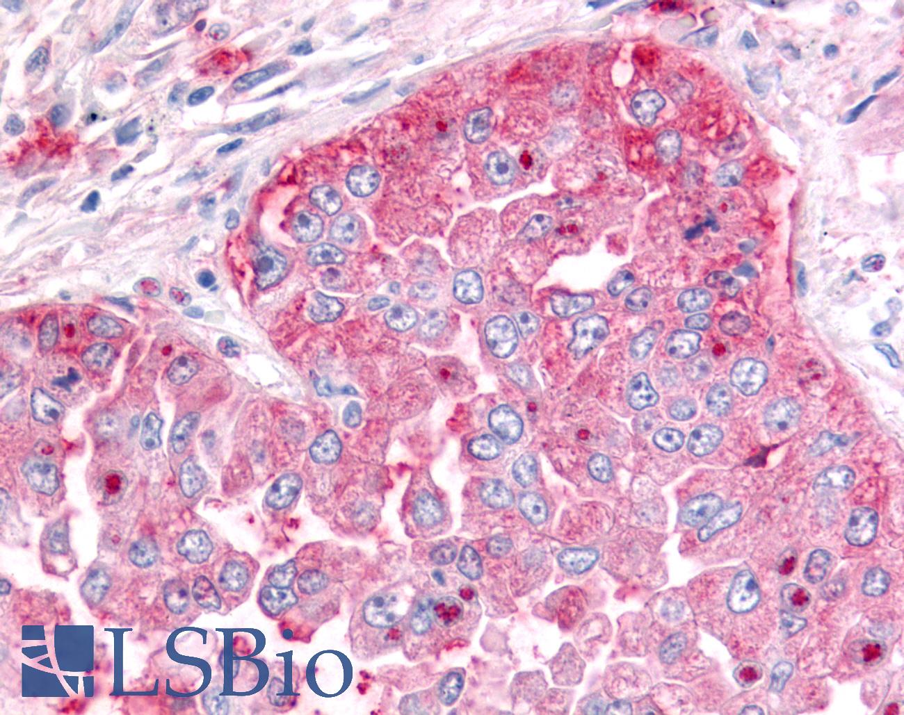 ADAMTS5 Antibody - Anti-ADAMTS5 antibody IHC of human Lung, Non-Small Cell Carcinoma. Immunohistochemistry of formalin-fixed, paraffin-embedded tissue after heat-induced antigen retrieval.