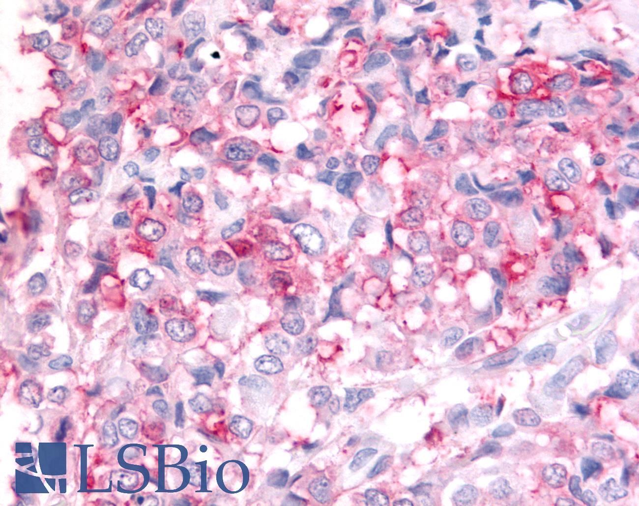 ADAMTS5 Antibody - Breast, Carcinoma