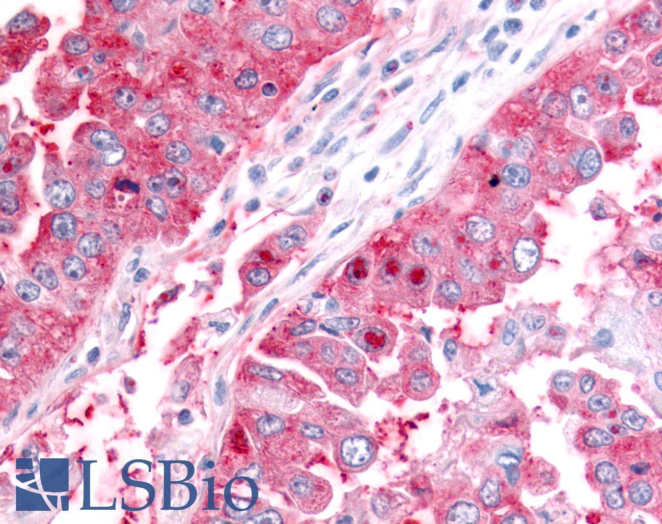 ADAMTS5 Antibody - Lung, Non Small-Cell Carcinoma